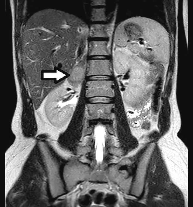 31 Management of adrenal incidentalomas KEVIN MURTAGH, NANA MUHAMMAD AND MAREK MILLER The return of a scan result with reference to an incidental finding of an adrenal mass is a common scenario.