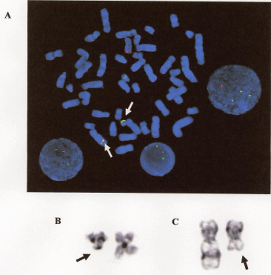 2 Classical and Molecular Cytogenetic Analysis of Hematolymphoid Disorders 57 Fig. 2.4 Common cytogenetic abnormalities in MPNs.