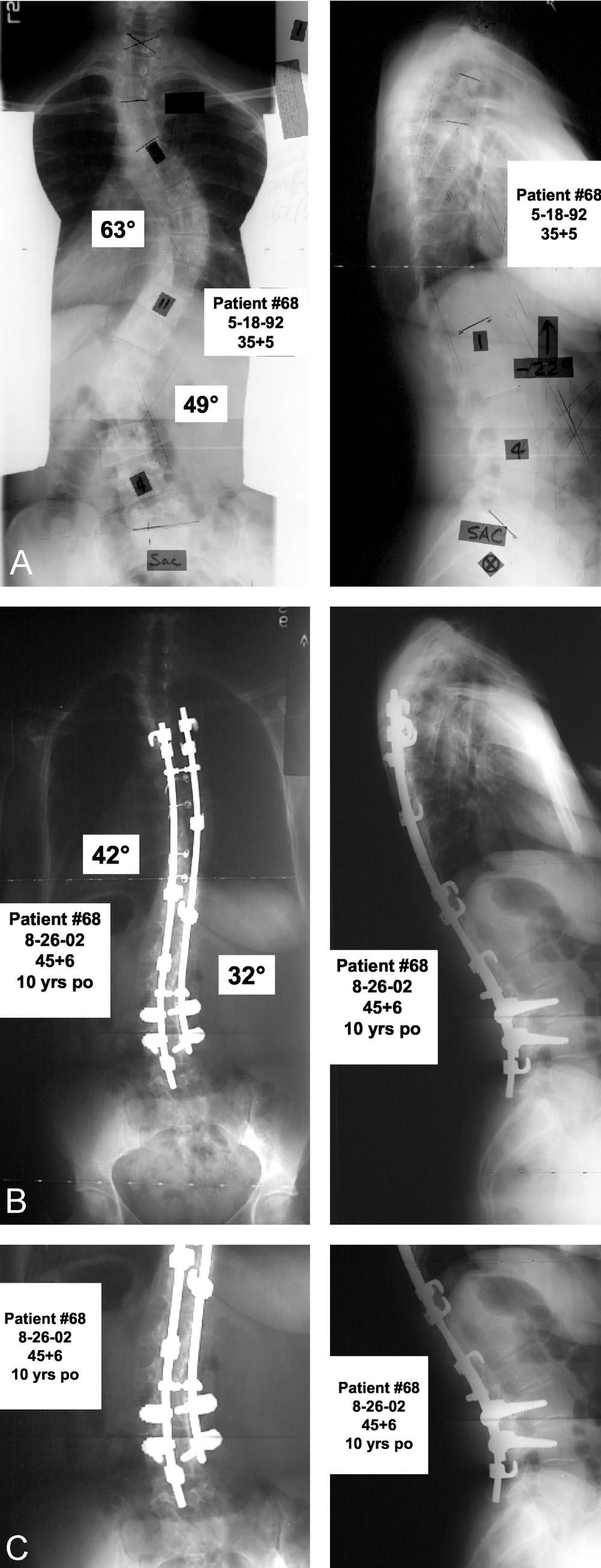 Late Complications of AIS Primary Fusions Rinella et al 321 Figure 2. A, Standing long cassette coronal and sagittal radiographs before surgery.