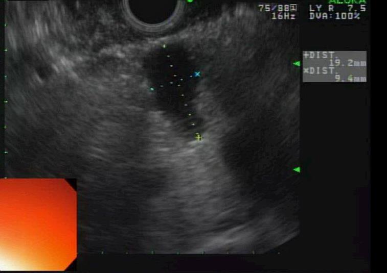 Endoscopic Ultrasound CEA was 121.