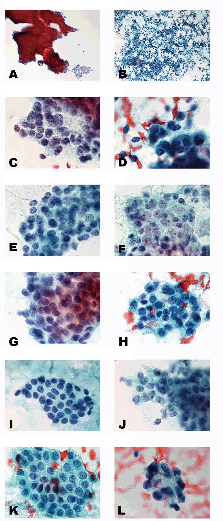 Oncocytology ;:. Figure : Overlapping pattern of the cells: A) Regulated, x, B) Deregulated, x (Stained by Papanicolaou s method).