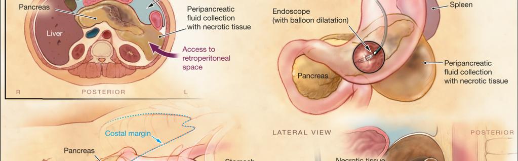 Endoscopic Transgastric vs Surgical