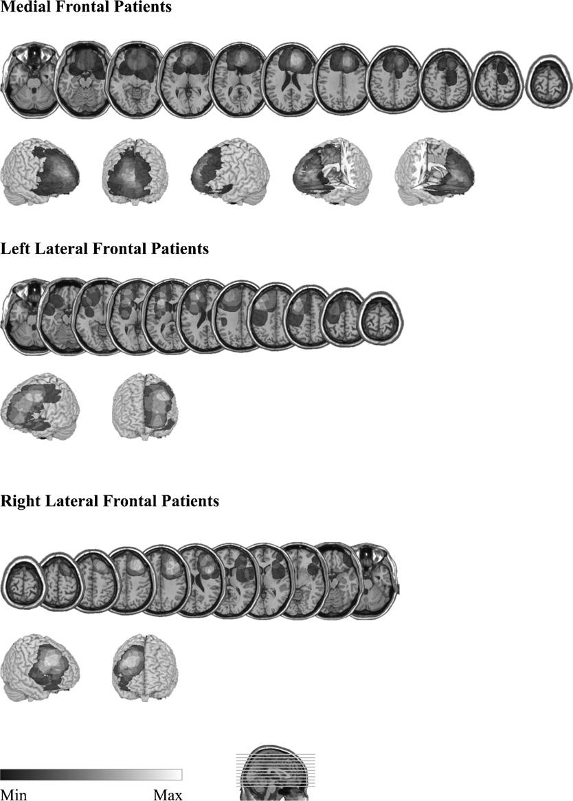 4 C. Reverberi et al. / Neuropsychologia xxx (2009) xxx xxx Fig. 1. Overlay lesion plots for the three lesion subgroups.