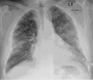 22 Non-Invasive Respiratory Support Techniques Case study 1.3 (Continued) Figure 1.7 Chest X-ray, Case 1.3. when they are stretched, as occurs in heart failure.