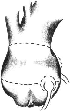 The Journal of Thoracic and Volume 117, Number 6 van Son et al 1153 C A B Fig 1.