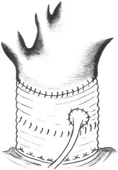 D in such proximity to the anulus that this prevents sufficient cephalad mobilization and reimplantation of the ostium (thus rendering reconstruction of that particular sinus with native tissue