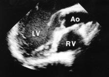 Transesophageal echocardiogram (transverse [A] and sagittal [B] views) of reconstructed aortic root with preservation of the native aortic valve and sinuses and replacement of the ascending aorta.