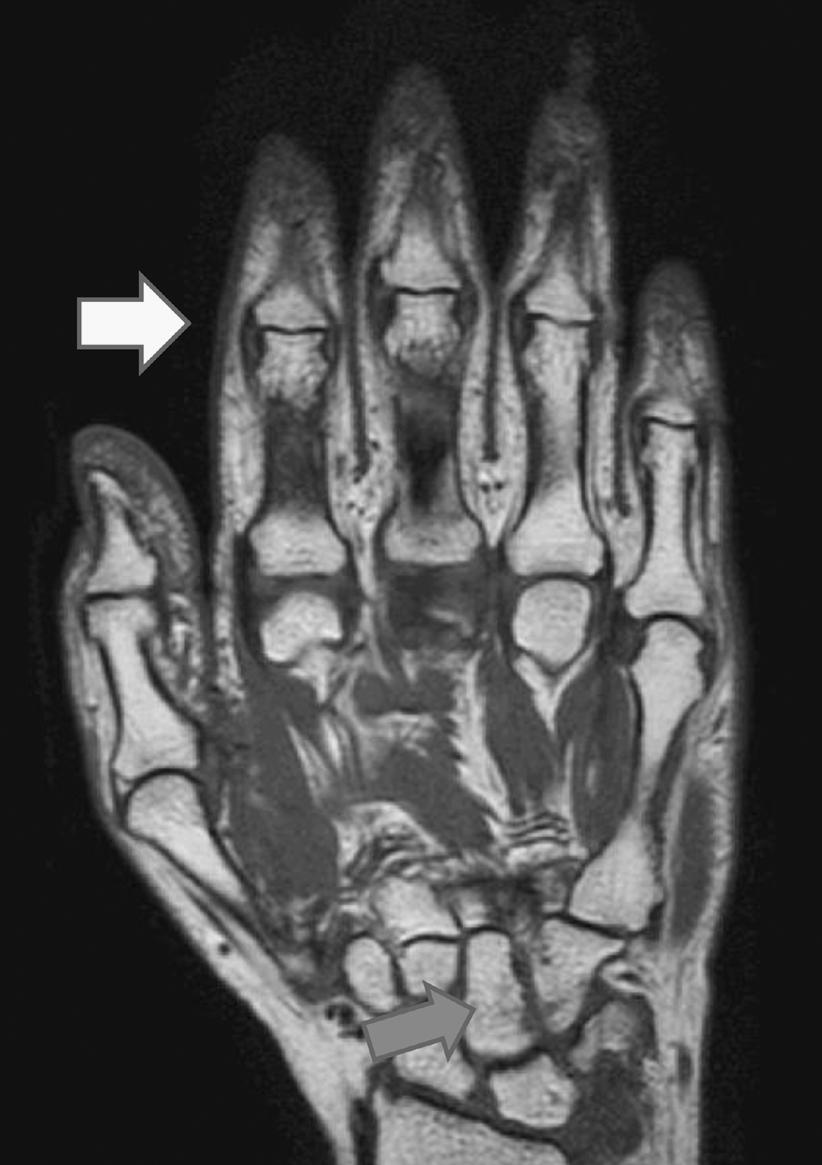 However, on magnetic resonance imaging (MRI) of the right hand, multiple erosions were observed in the MCP joints and the wrist and synovitis and edema were observed around the PIP and DIP.