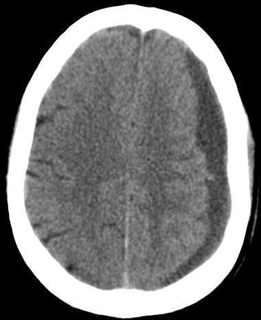 There is an associated scalp hematoma.