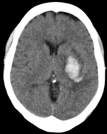 36 Figure 13: Intracerebral Bleed Figure 13 above shows a hyperdense lesion in the left basal ganglia region with compression