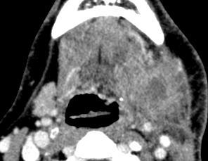(yellow arrow) (B) Submandibular abscess and duct obstruction