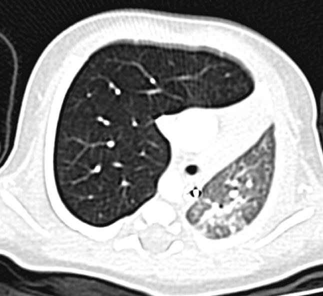 Tension pulmonary anomalycongenital lobar emphysema The large volume of the affected lobe of the lung with higher