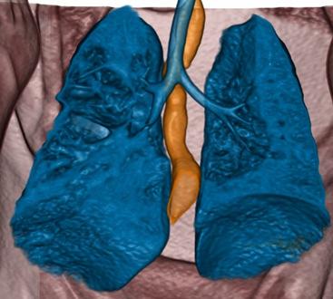 of the lungs, with mediastinal