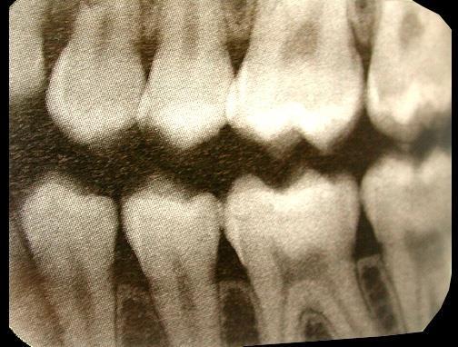 Radiograph of teeth remarkable