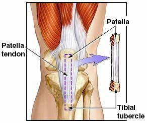 ACL Reconstruction Surgery Surgical reconstruction of a torn ACL involves replacing the torn ACL with a tendon (called a graft) from another part of the knee or a cadaver donor, and putting it into a