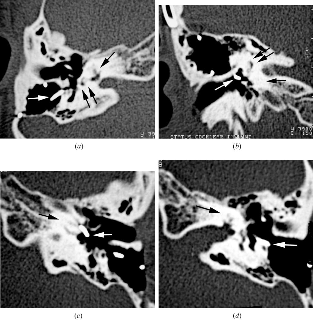 290 CLINICAL RADIOLOGY Fig. 4 Case 1. (a) Axial and (b) coronal CT of right temporal bone showing complete ossification of the cochlea (single black arrow) and the vestibule (double black arrows).