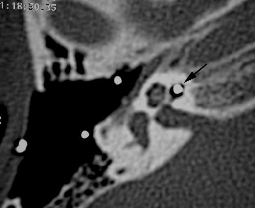 (c) And (d) axial CT of left temporal bone in the same patient showing the electrode (single white arrow) in the middle ear cavity and not entering the ossified cochlea (single black arrow).