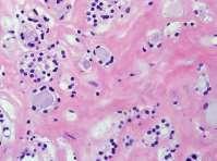 carcinoma are embedded in the fibrosis.