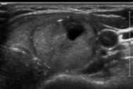 (A) The ultrasound image shows a wellcircumscribed, isoechoic, ovoid nodule with