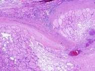 (C) The core needle biopsy shows a macrofollicular proliferative lesion with a