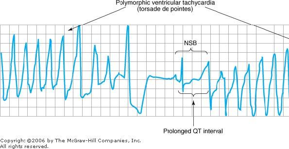 17 Figure 14 7 Electrocardiogram from a patient with the long QT syndrome during two episodes of torsade de pointes.