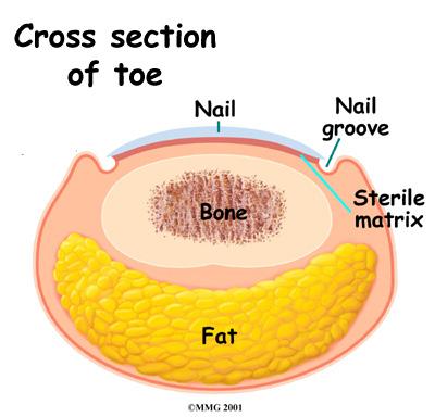 Most of us have lost either a fingernail or toenail and watched as the nail regrew slowly over several months. The area under the nail that attaches the nail to the toe is called the sterile matrix.