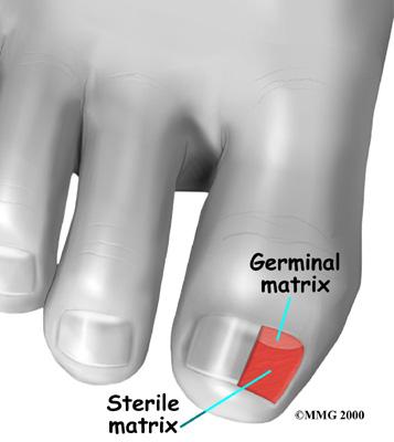 On either side of the nail is an area called the nail groove, where the skin of the toe meets the nail matrix and the edge of the toenail. Causes How does the problem develop?