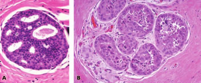 Biopsy of Atypical Ductal Hyperplasia Fig. 1 Atypical ductal hyperplasia.