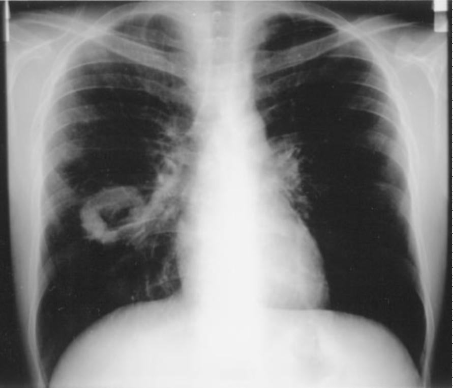 pulmonary manifestations were explored by means of CT.