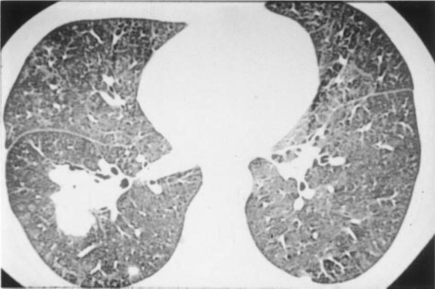 PTNBs of the pulmonary masses were performed in six patients. Histologic analysis led to the diagnosis of NHL in four cases.
