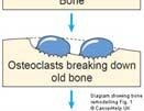 Bone cell activity in myeloma