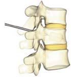 Vertebroplasty Painful vertebral