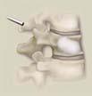 of bone cement Stabilised vertebral
