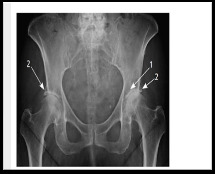 Figure 2. Radiograph of the hips showing (1) joint space narrowing and (2) osteophyte formation. Sinusas,K. 2012. osteoarthritis: diagnosis and treatment (photograph). Retrieved from http://www.aafp.