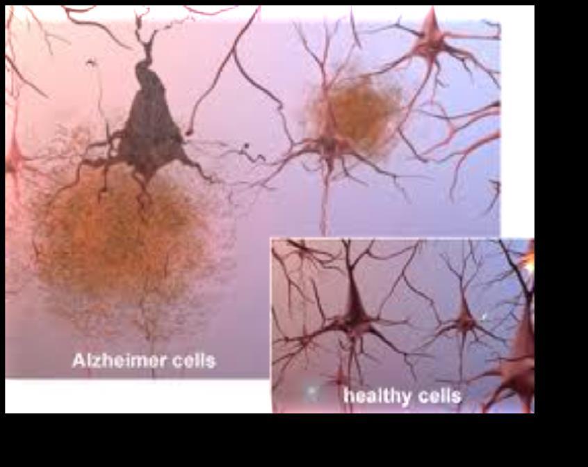 Alzheimer s Disease Most common form of dementia. Exact cause unknown but includes some mix of genetic, environmental, and lifestyle factors. Gradual onset. Short term memory.