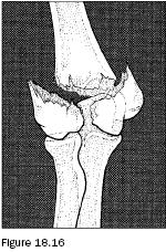 18.1 Upper Extremity Injuries Supracondylar Fractures of the Humerus Fracture patterns include: Supracondylar