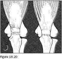 18.1 Upper Extremity Injuries Supracondylar Fractures of the Humerus Treatment