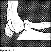 18.1 Upper Extremity Injuries Olecranon Fractures Olecranon fractures result from a fall on