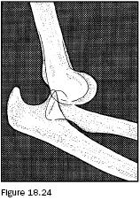 18.1 Upper Extremity Injuries Elbow Dislocation Dislocations of the elbow occur with a fall on