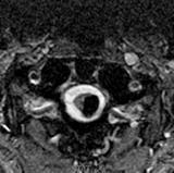 Cavernous Malformation Cavernous Malformation: Ddx Intramedullary neoplasm: ependymoma, astrocytoma, hemangioblastoma, metastases Arteriovenous malformation AX GRE Spinal Cord