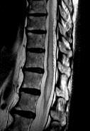 Spinal Type 1: Spinal Dural AVF Bilateral
