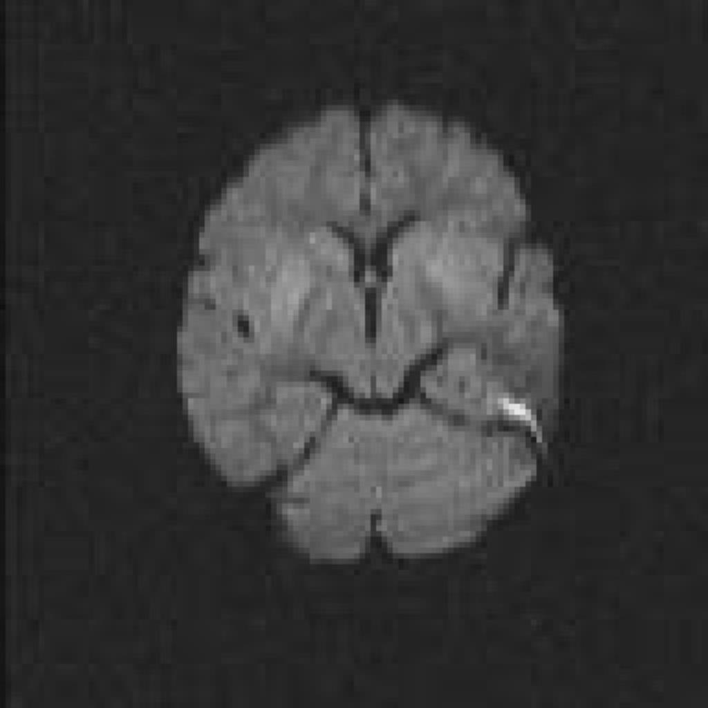 Fig.: Fig.: DWI (Diffusion weighted image) shows restricted diffusion in both basal ganglia Bithalamic involvement is as common as basal ganglia involvement.