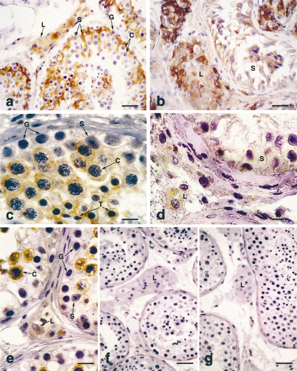 232 MARCHETTI ET AL. FIG. 1. Immunolocalization of inhibin and B subunits in human adult testes. a, b) Immunostaining for subunit in testes with normal spermatogenesis (a) or Sertoli cell only (b).