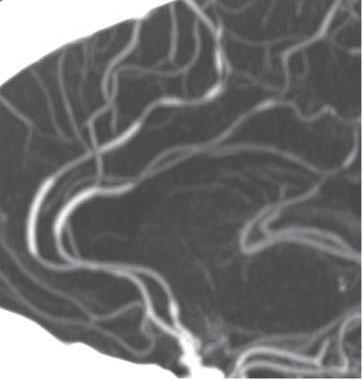 Vasculopathies associated with preeclampsia/eclampsia Reversible Cerebral Vasoconstriction Syndrome (RCVS) Diffuse or multifocal segmental narrowing in