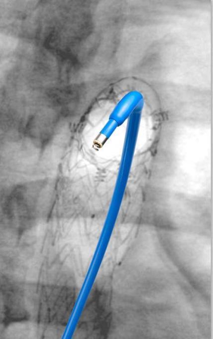 Role of Heli-FX Thoracic EndoAnchor System in TEVAR Enhances sealing & fixation of endografts Simplifies revisions
