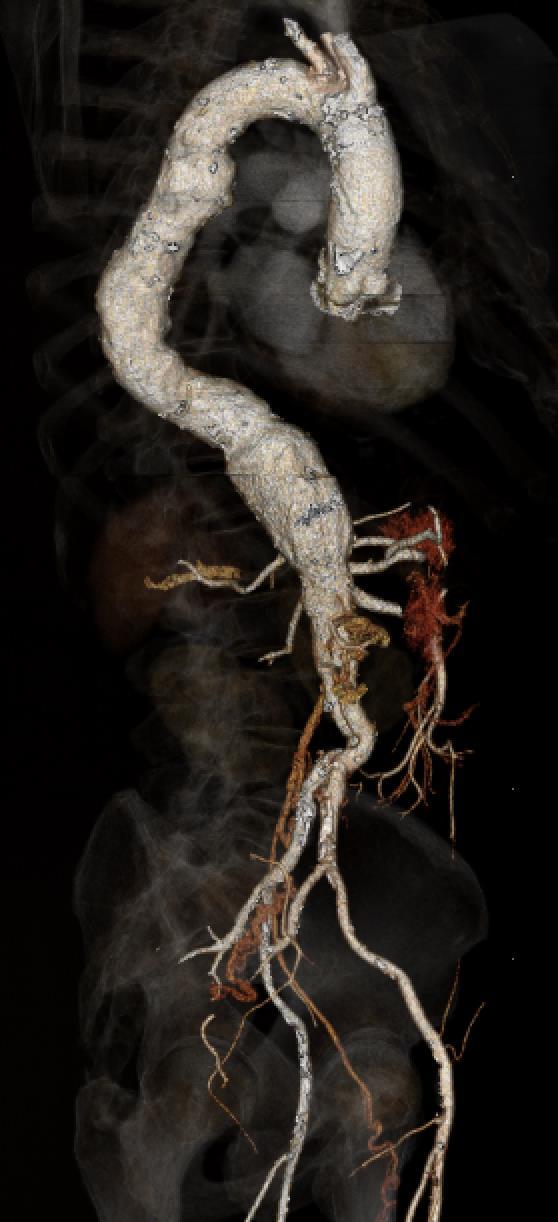 5 cm aneurysm of lower descending