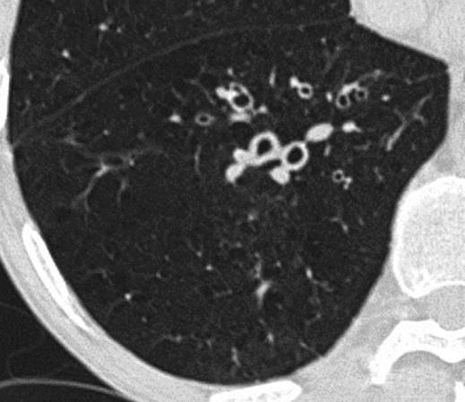 Fig. 1 High-resolution CT image in 76-year-old man with emphysema and bronchial wall thickening within right lower lobe that was scored as grade 1 by both radiologists (bronchial dilatation score,