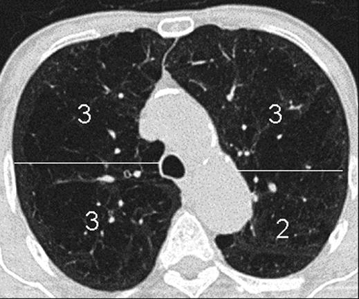 Functional Impairment in Emphysema and four levels in the caudal part of the lung were selected; the most cranial slice was at the level of the great vessels.