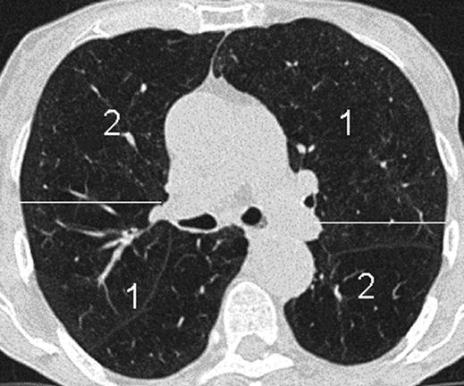 Three levels interspaced by 20 mm cranial to this were selected. The uppermost image from the cranial lung and the uppermost image from the caudal lung were regarded as an image pair.