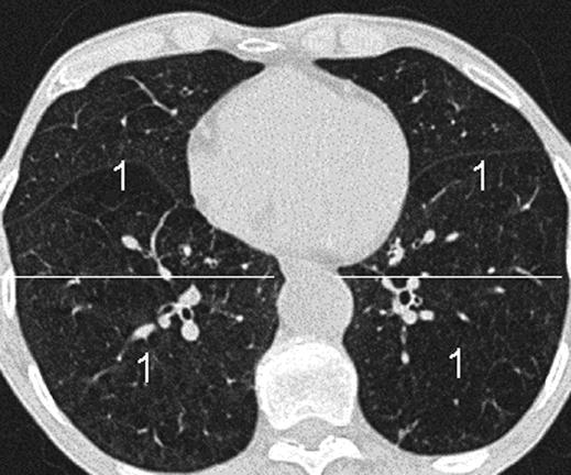 Image pairs were classified into five grades of heterogeneity: 1, obviously more emphysema in the cranial image; 2, somewhat more emphysema in the cranial image; 3, equal extent of emphysema; 4,